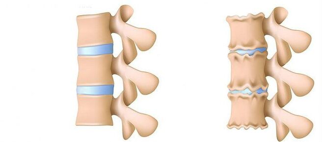 Osteochondrosis in the lumbar region
