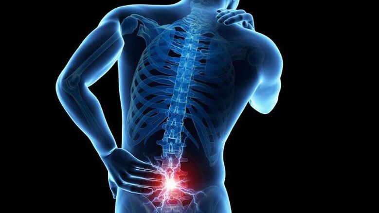 Lumbar osteochondrosis symptoms